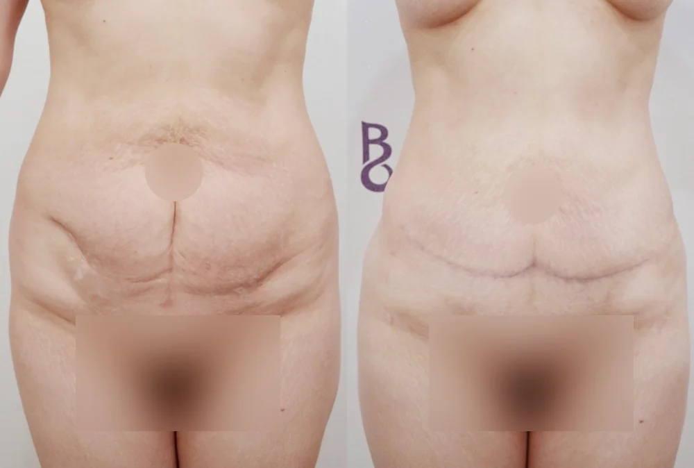 체형성형센터 시술 전후 사진 6 · 보니따의원