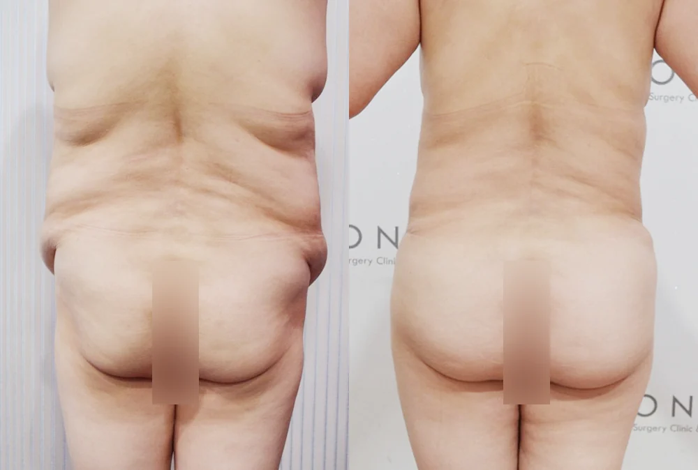 체형성형센터 시술 전후 사진 10 · 보니따의원
