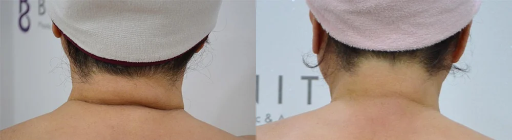 지방흡입 시술 전후 사진 21 · 보니따의원