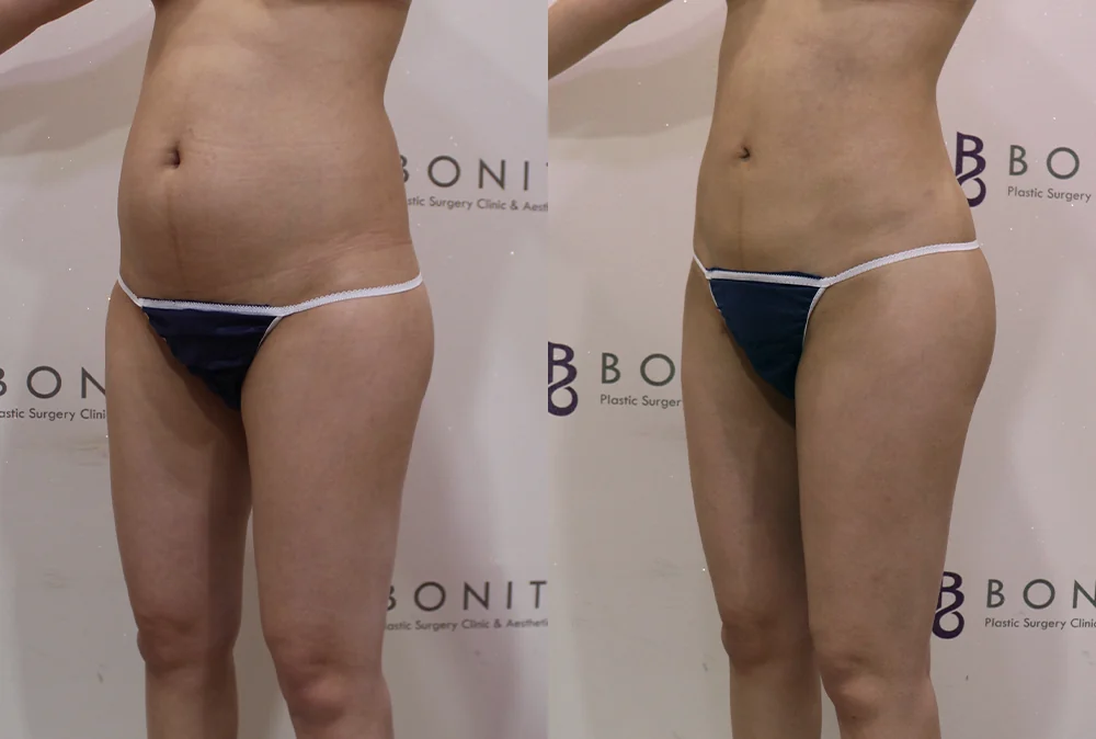 Liposuction in Seoul: Does Removing More Fat Give You a Better Shape? · Before and after 2