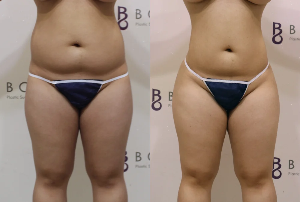 Liposuction in Seoul: Does Removing More Fat Give You a Better Shape? · Before and after 1