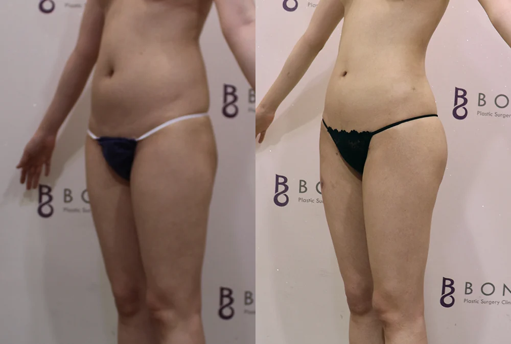 원데이 지방흡입 시술 전후 사진 3 · 보니따의원