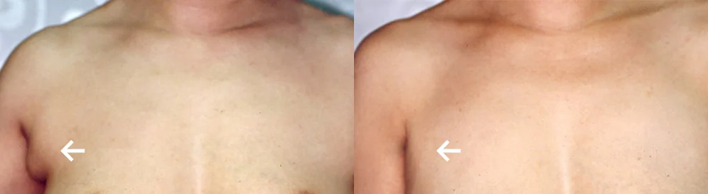 지방흡입 시술 전후 사진 28 · 보니따의원