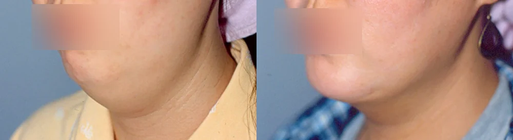 지방흡입 시술 전후 사진 31 · 보니따의원