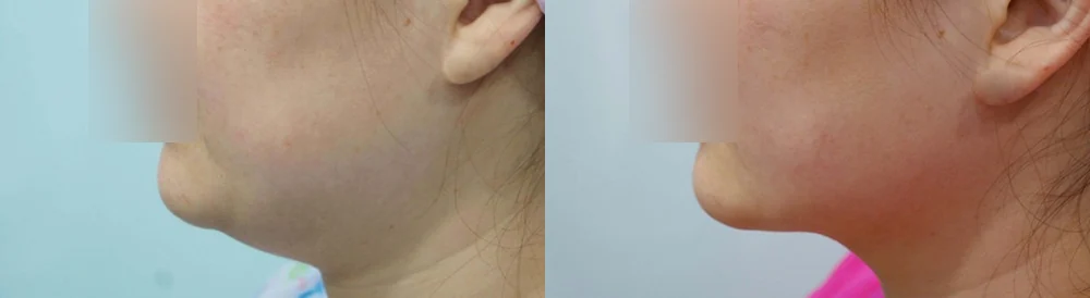원데이 지방흡입 시술 전후 사진 11 · 보니따의원