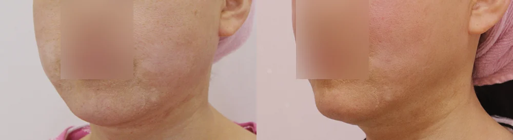 원데이 지방흡입 시술 전후 사진 12 · 보니따의원