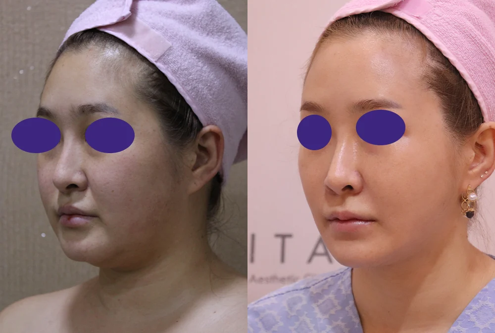 지방흡입 시술 전후 사진 10 · 보니따의원