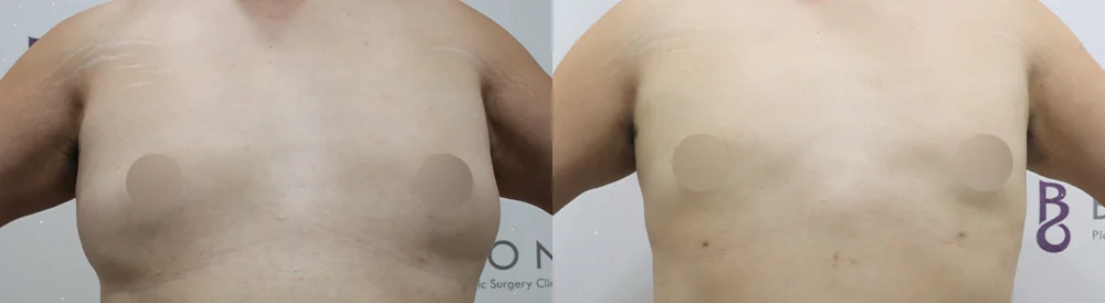 원데이 지방흡입 시술 전후 사진 15 · 보니따의원