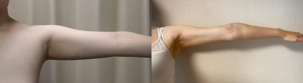 지방흡입 시술 전후 사진 42 · 보니따의원