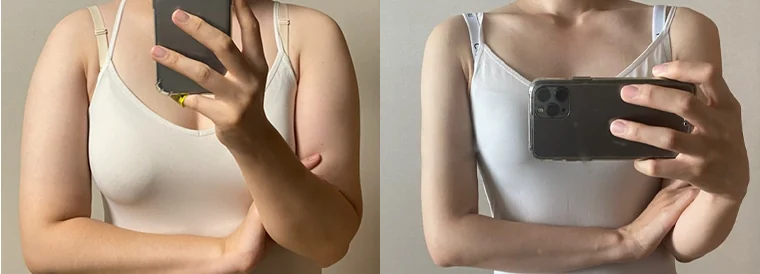 지방흡입 시술 전후 사진 17 · 보니따의원