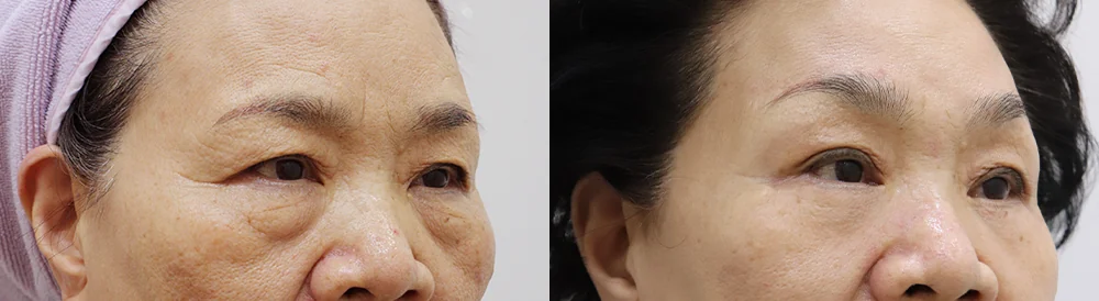 눈밑지방재배치 시술 전후 사진 3 · 보니따의원