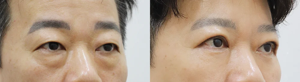 눈밑지방재배치 시술 전후 사진 12 · 보니따의원