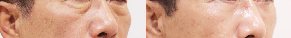 눈밑지방재배치 시술 전후 사진 22 · 보니따의원