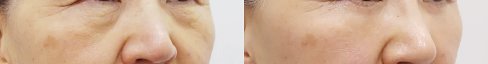 눈밑지방재배치 시술 전후 사진 25 · 보니따의원