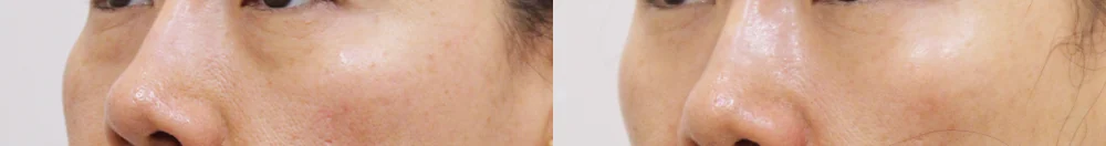 눈밑지방재배치 시술 전후 사진 28 · 보니따의원