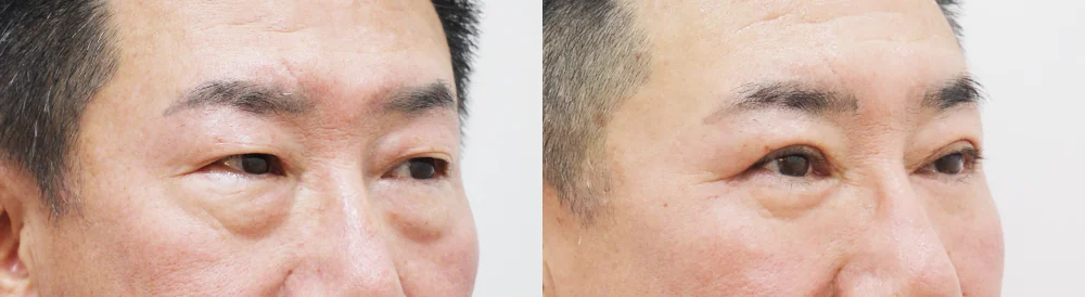 중년 눈 성형 시술 전후 사진 4 · 보니따의원