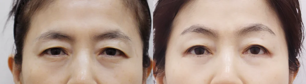 중년 눈 성형 시술 전후 사진 6 · 보니따의원