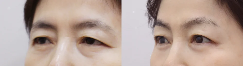 중년 눈 성형 시술 전후 사진 7 · 보니따의원