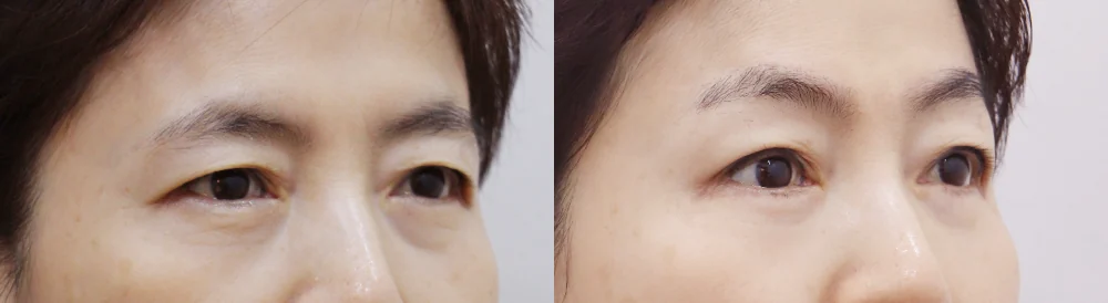 중년 눈 성형 시술 전후 사진 8 · 보니따의원