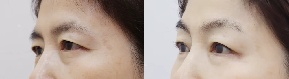 중년 눈 성형 시술 전후 사진 9 · 보니따의원