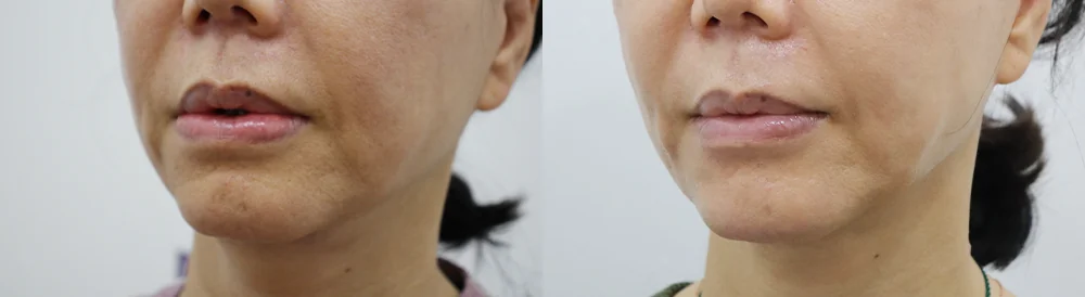 입술 필러·이물질이 뭉치고 굳었다면, 빼낼 수 있을까요? · 전후 사진 4