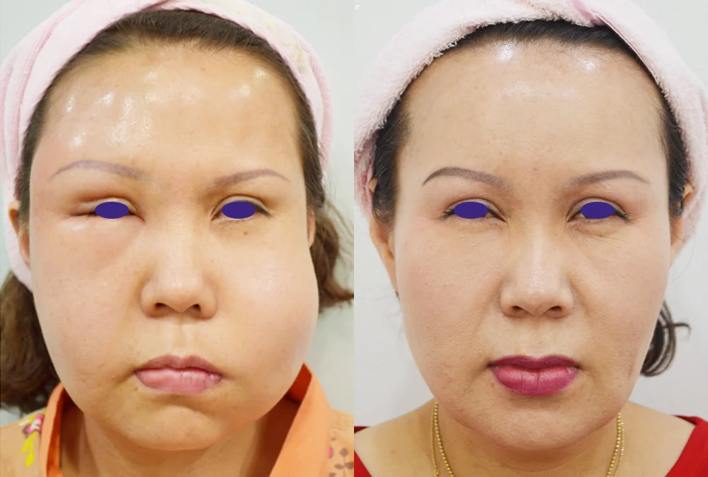 입술 필러·이물질이 뭉치고 굳었다면, 빼낼 수 있을까요? · 전후 사진 2