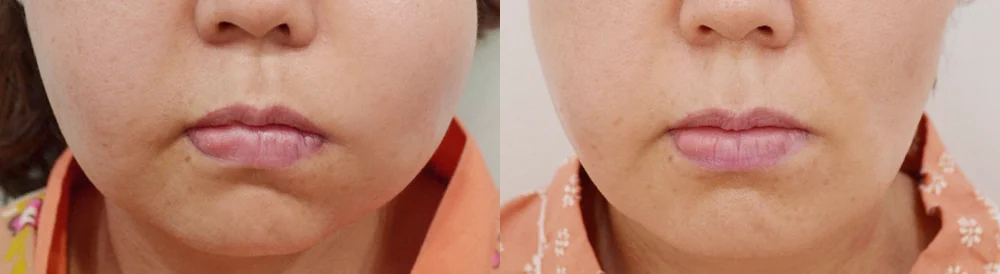 이물질 제거 후 멀티 리프팅 시술 전후 사진 5 · 보니따의원
