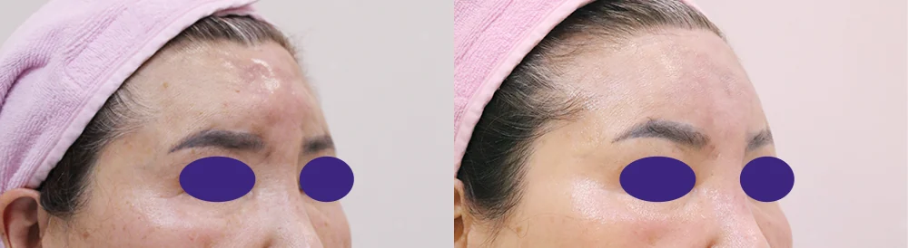 이물질 제거 후 멀티 리프팅 시술 전후 사진 6 · 보니따의원