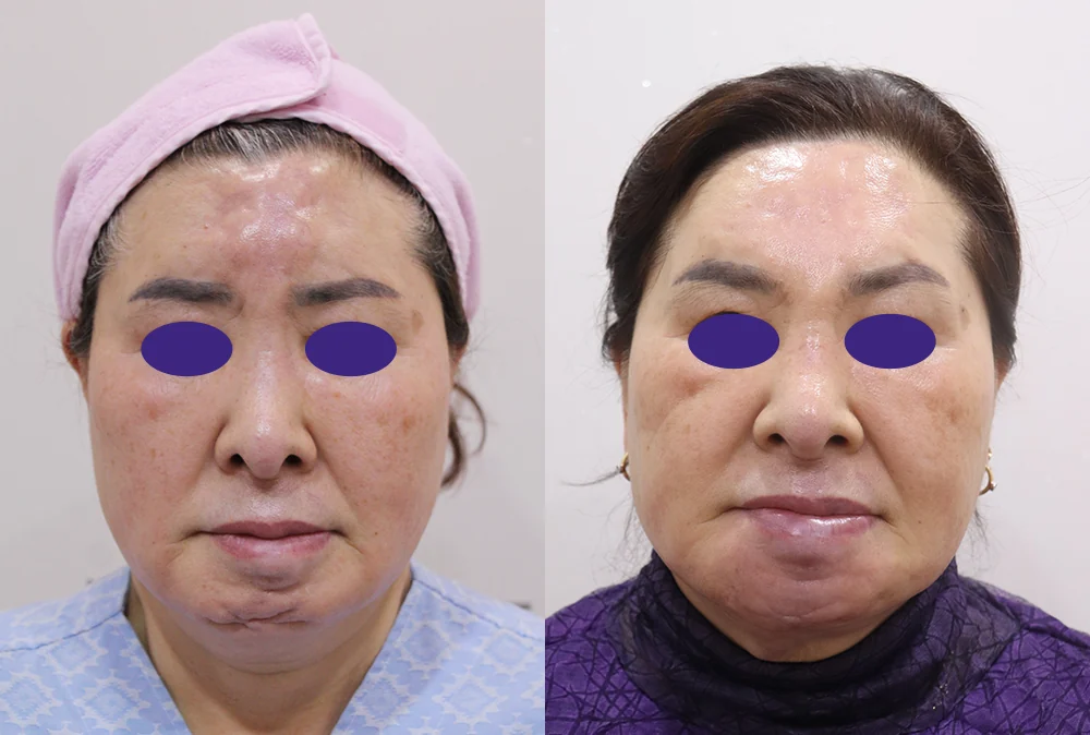이물질 제거 후 멀티 리프팅 시술 전후 사진 1 · 보니따의원