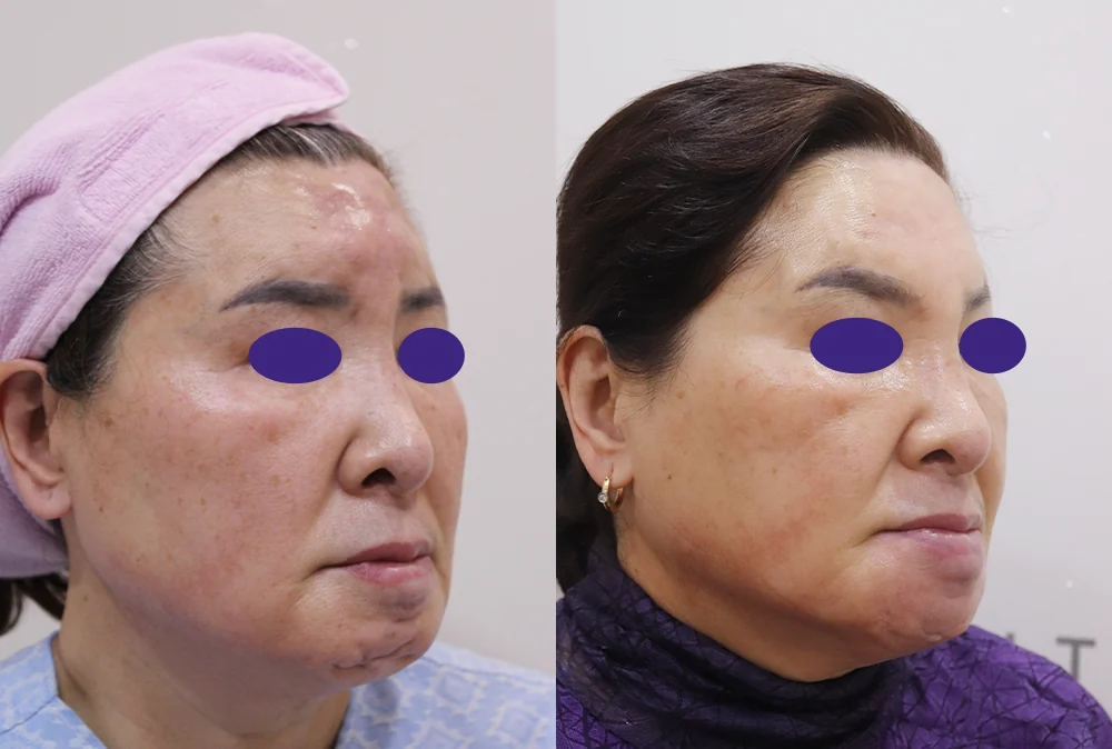 필러·이물질을 뺀 뒤 얼굴이 꺼지고 처졌다면, 리프팅은 언제 어떻게 하나요? · 전후 사진 1