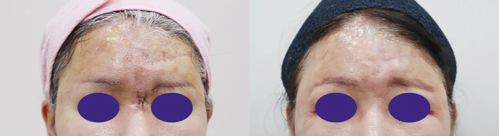필러·이물질을 뺀 뒤 얼굴이 꺼지고 처졌다면, 리프팅은 언제 어떻게 하나요? · 전후 사진 2