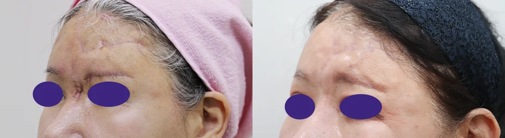 이물질 제거 후 멀티 리프팅 시술 전후 사진 7 · 보니따의원