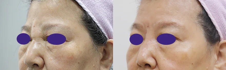 이물질 제거 후 멀티 리프팅 시술 전후 사진 2 · 보니따의원