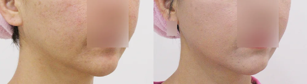 흉터 제거 후 멀티 리프팅 시술 전후 사진 2 · 보니따의원