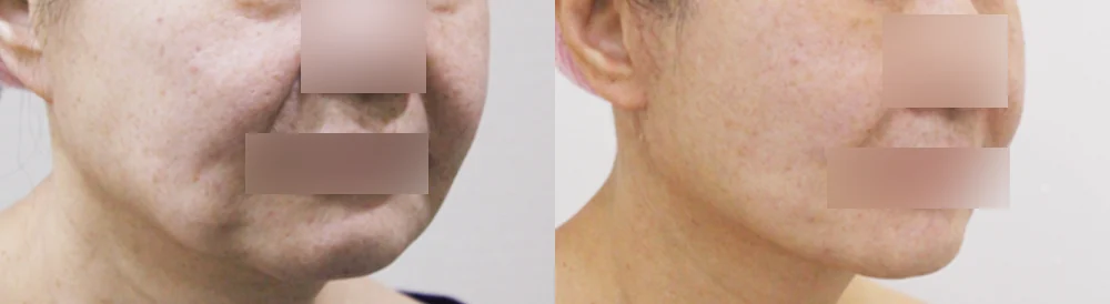 흉터 제거 후 멀티 리프팅 시술 전후 사진 4 · 보니따의원