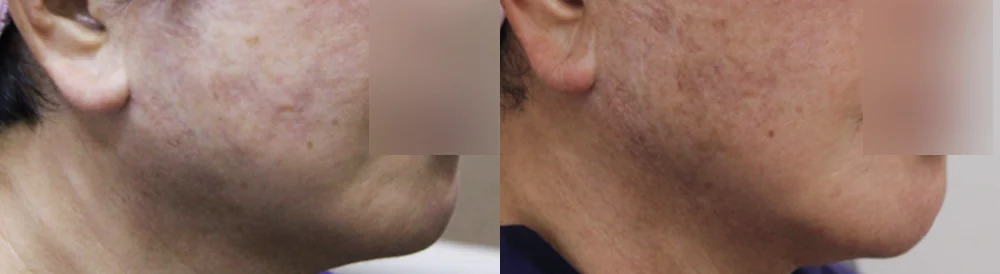 흉터 치료와 리프팅, 같이 해도 될까요? 무엇을 먼저 해야 하나요? · 전후 사진 2