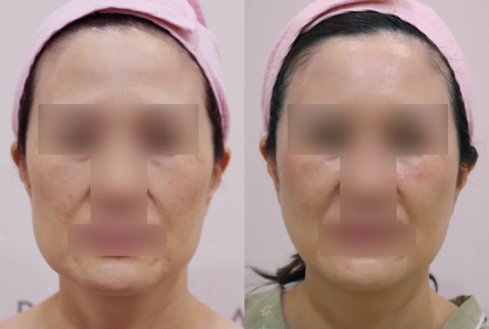 Multi-Lifting in Seoul: Combining Liposuction, Threads, Fat Grafting and Laser by the Cause of Sagging · Before and after 1