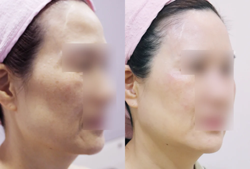 Multi-Lifting in Seoul: Combining Liposuction, Threads, Fat Grafting and Laser by the Cause of Sagging · Before and after 3