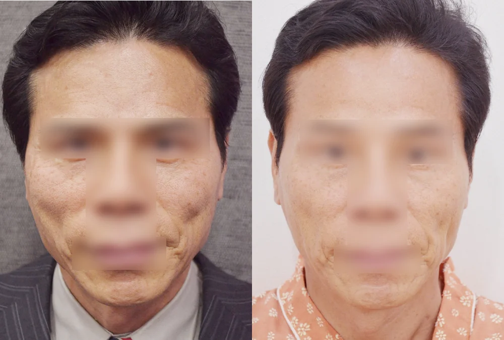 멀티리프팅 시술 전후 사진 4 · 보니따의원