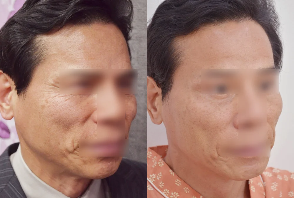 Multi-Lifting in Seoul: Combining Liposuction, Threads, Fat Grafting and Laser by the Cause of Sagging · Before and after 2