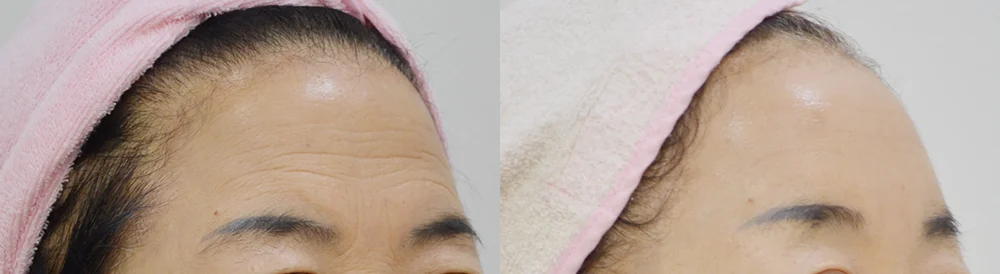 멀티리프팅 시술 전후 사진 30 · 보니따의원