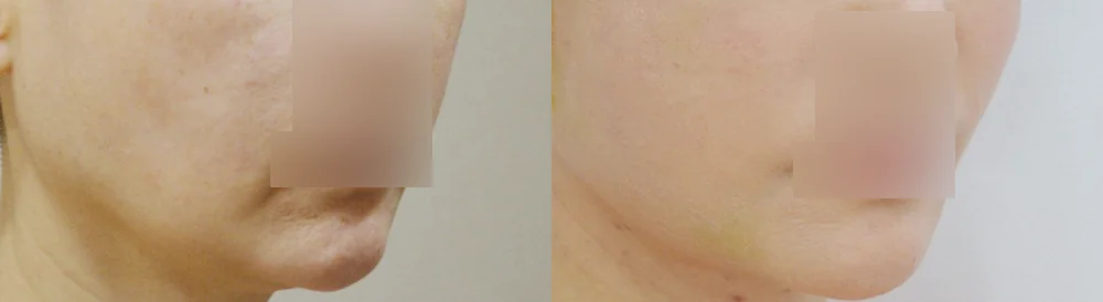 멀티리프팅 시술 전후 사진 33 · 보니따의원
