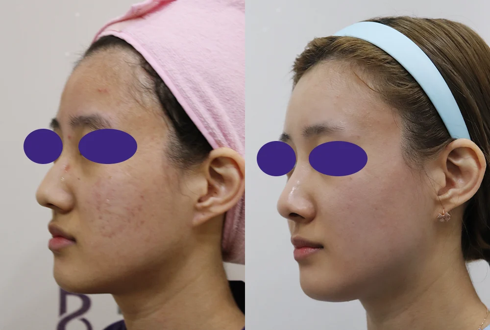 코 성형 시술 전후 사진 3 · 보니따의원