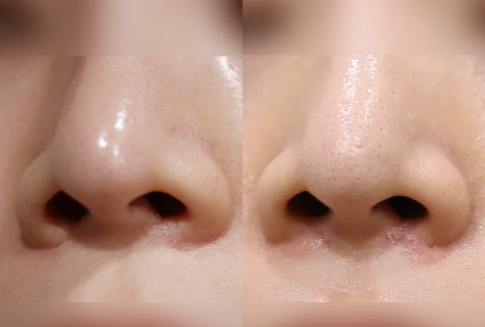 코 흉터 시술 전후 사진 3 · 보니따의원
