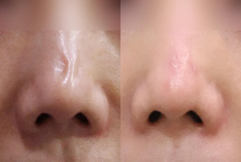 코 흉터, 레이저로 좋아질까요? 수술이 필요할까요? · 전후 사진 1