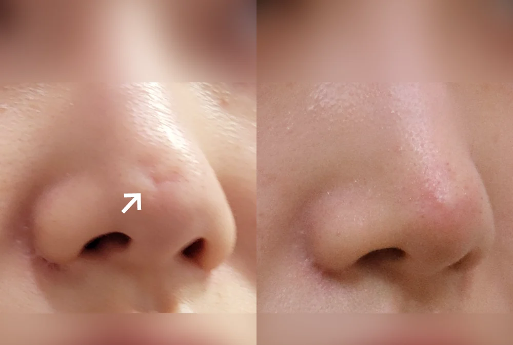 코 흉터 시술 전후 사진 7 · 보니따의원