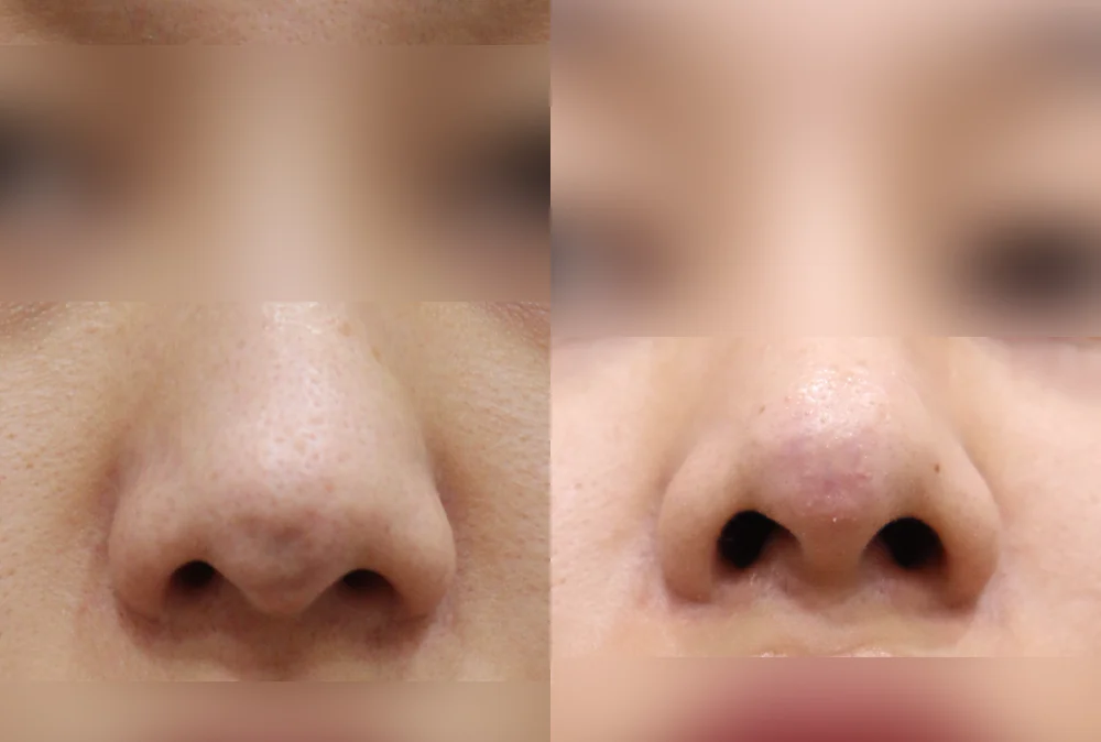 코 흉터 시술 전후 사진 12 · 보니따의원