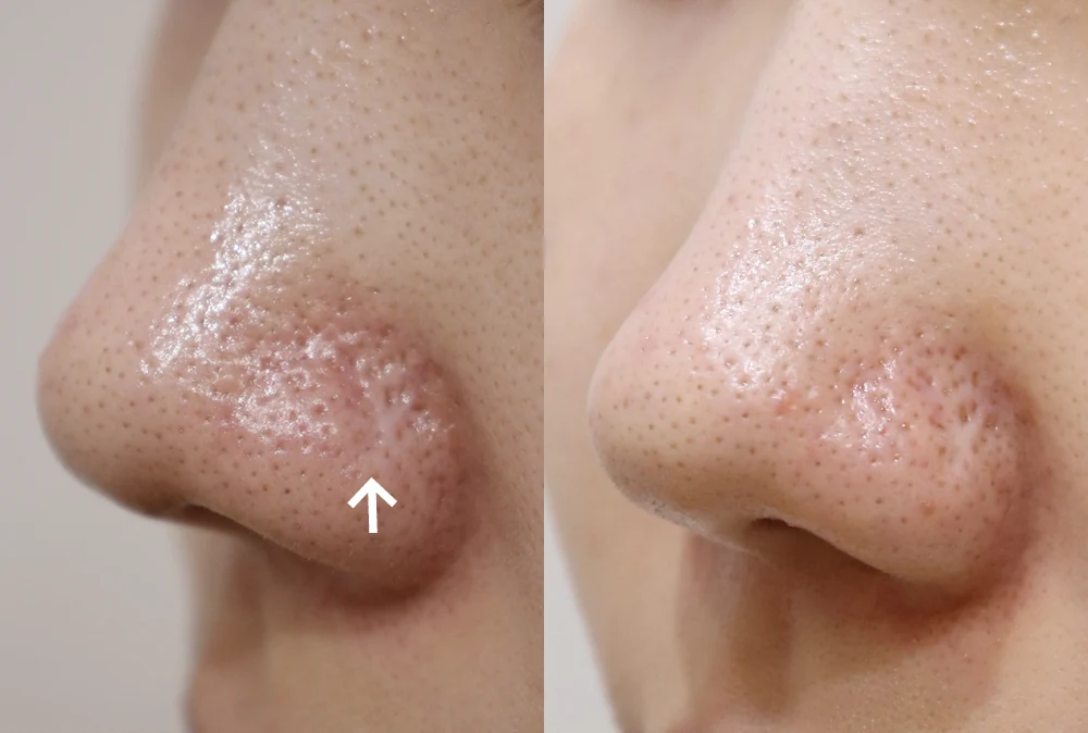 코 흉터, 레이저로 좋아질까요? 수술이 필요할까요? · 전후 사진 3