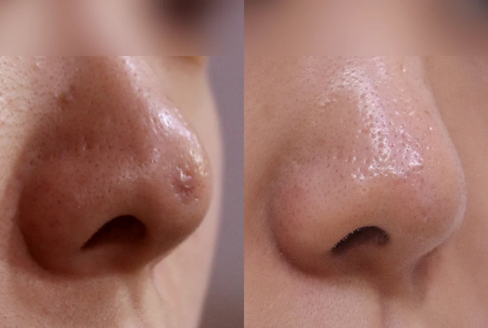 코 흉터 시술 전후 사진 20 · 보니따의원