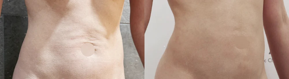 체형성형센터 시술 전후 사진 16 · 보니따의원